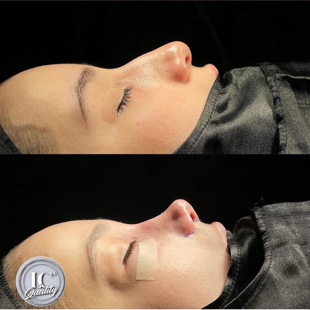 Before and After Result